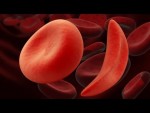 anemia falciforme