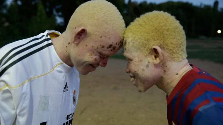 Albinismo: Entenda o que é, cuidados, e mais