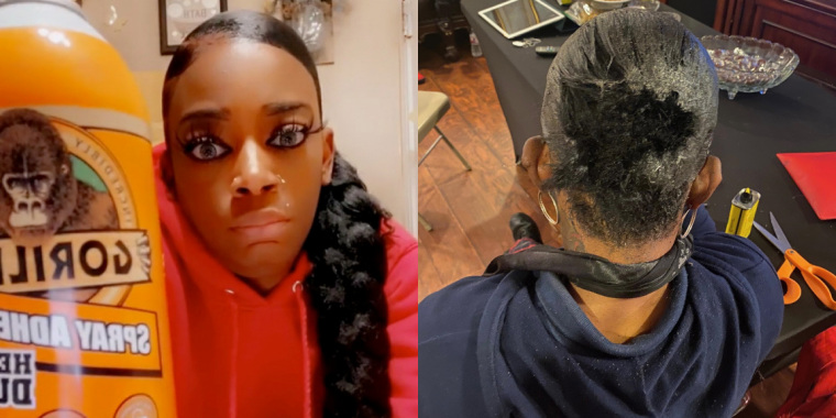 Após usar cola industrial para ‘alisar’ o cabelo, mulher passa por procedimento dermatológico no coro cabeludo